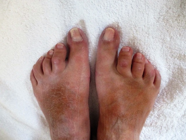 reuma voet